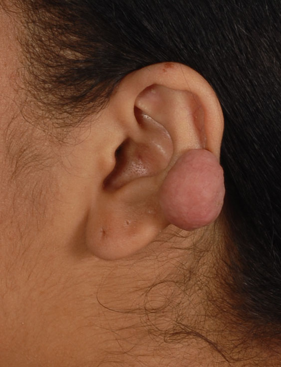 Keloid Case 2831 Before Photo Keloid