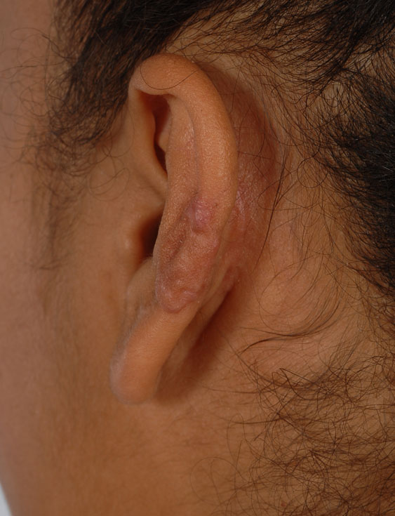 Keloid Case 2831 After Photo Keloid