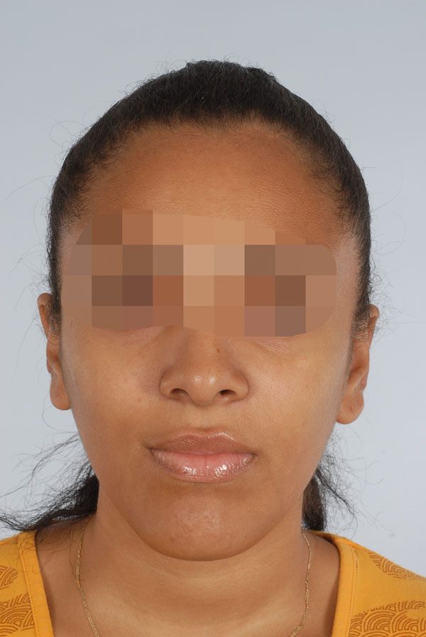 Keloid Case 2831 After Photo Keloid