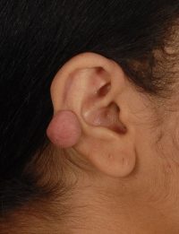 Keloid