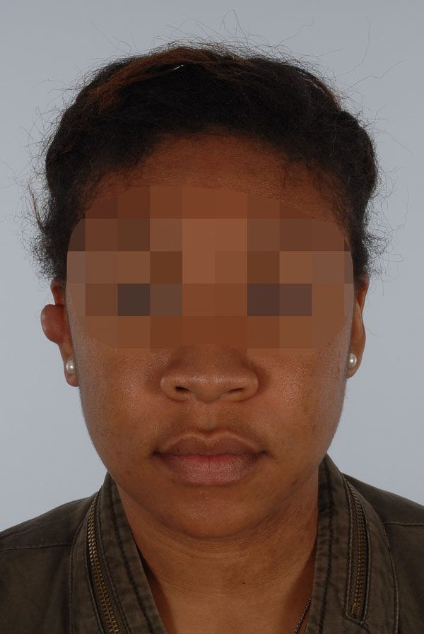 Keloid Case 2839 Before Photo Keloid