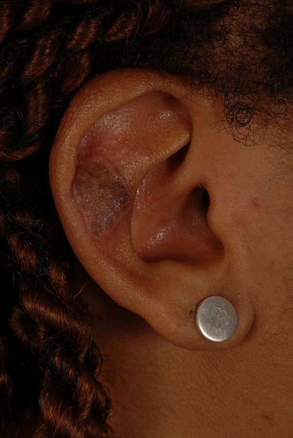 Keloid Case 2839 After Photo Keloid