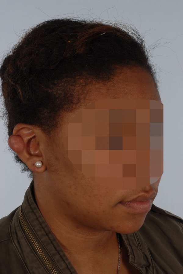 Keloid Case 2839 Before Photo Keloid