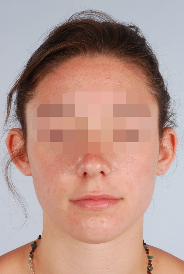Otoplasty Case 2847 Before Photo Otoplasty