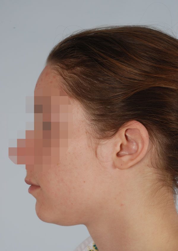 Otoplasty Case 2847 After Photo Otoplasty