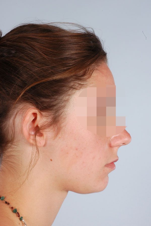 Otoplasty Case 2847 Before Photo Otoplasty