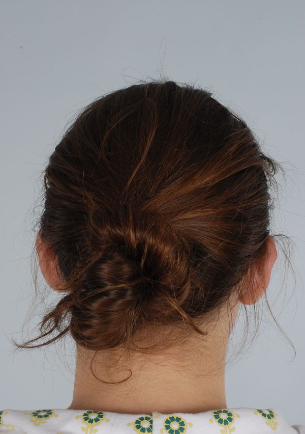 Otoplasty Case 2847 After Photo Otoplasty