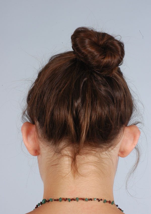 Otoplasty Case 2847 Before Photo Otoplasty