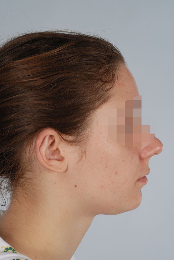 Otoplasty Case 2847 After Photo Otoplasty