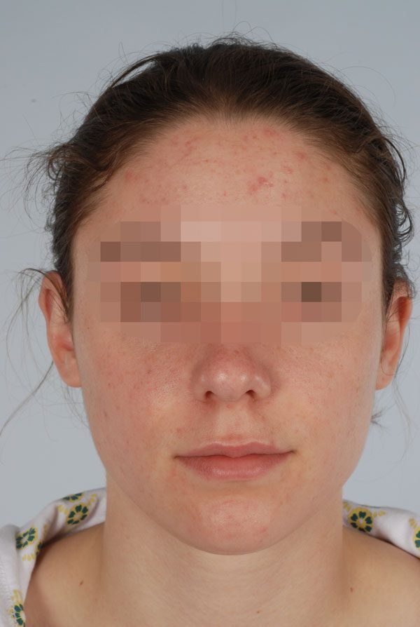 Otoplasty Case 2847 After Photo Otoplasty
