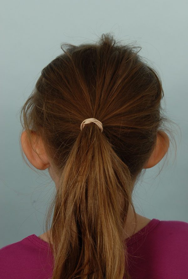 Otoplasty Case 2857 Before Photo Otoplasty