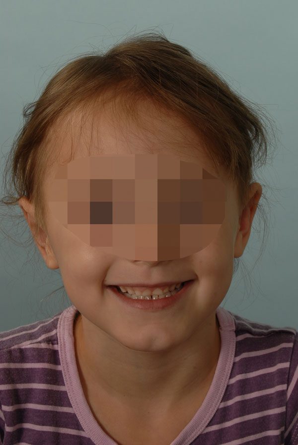 Otoplasty Case 2857 After Photo Otoplasty