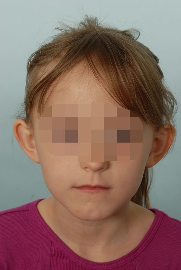 Otoplasty Case 2857 Before Photo Otoplasty