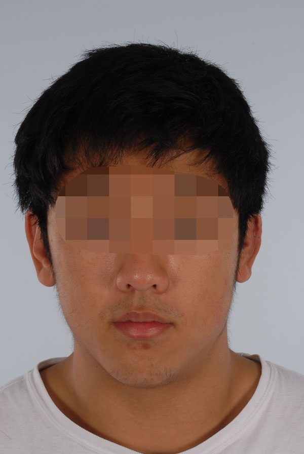 Otoplasty Case 2863 After Photo Otoplasty