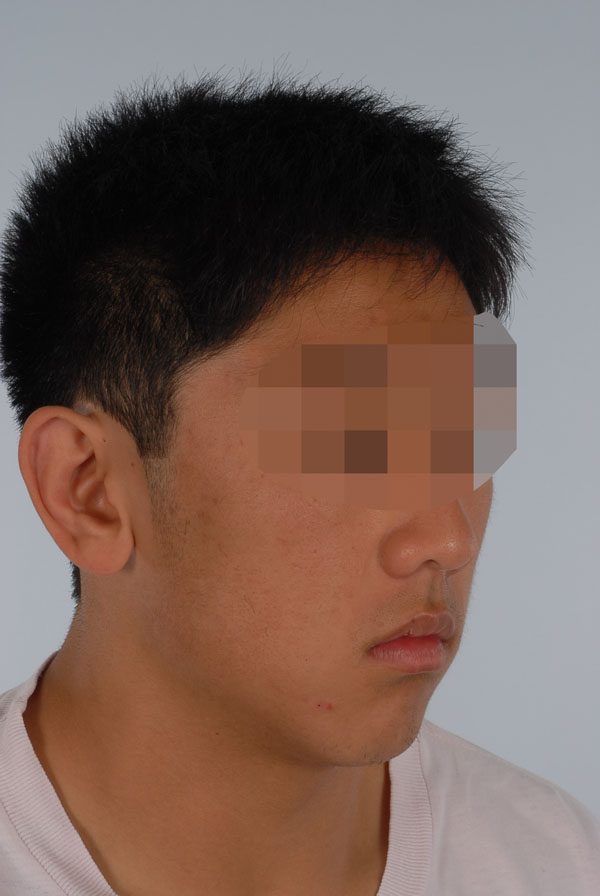 Otoplasty Case 2863 Before Photo Otoplasty