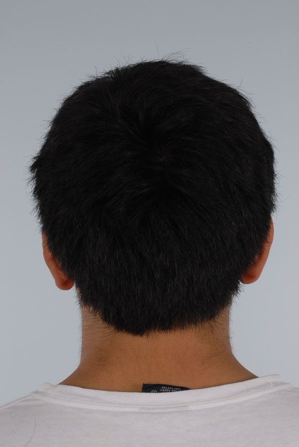 Otoplasty Case 2863 After Photo Otoplasty