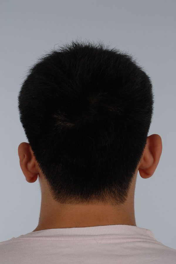 Otoplasty Case 2863 Before Photo Otoplasty