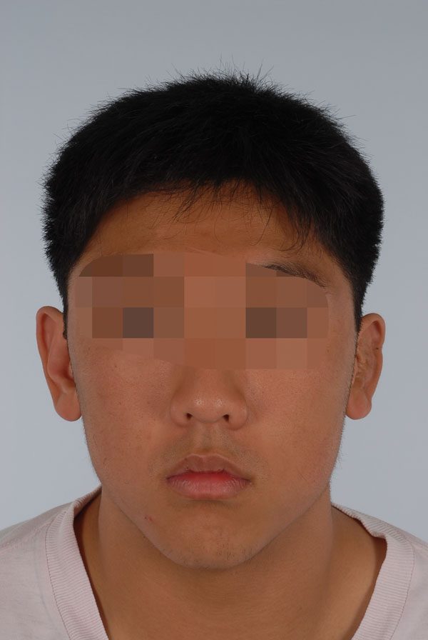 Otoplasty Case 2863 Before Photo Otoplasty