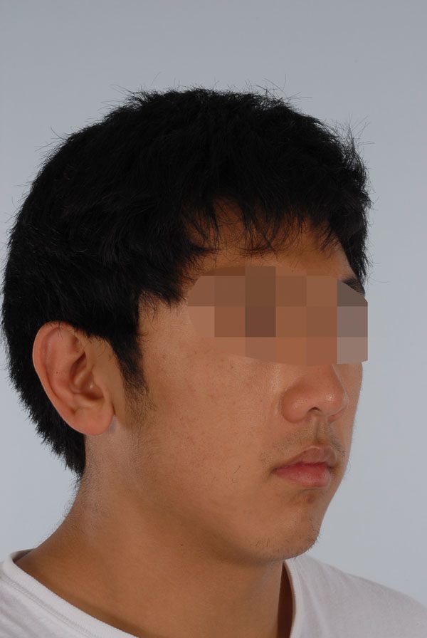 Otoplasty Case 2863 After Photo Otoplasty