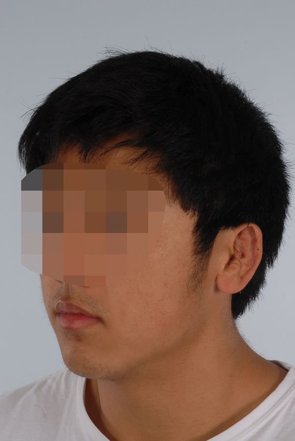 Otoplasty Case 2863 After Photo Otoplasty