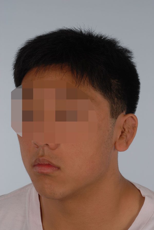Otoplasty Case 2863 Before Photo Otoplasty