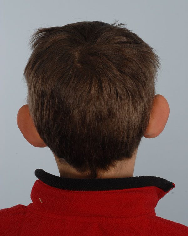 Otoplasty Case 2883 Before Photo Otoplasty