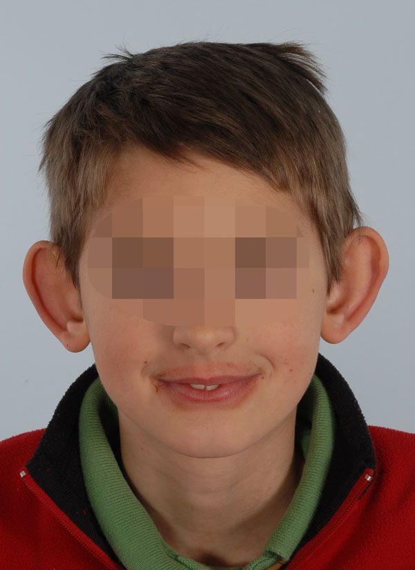 Otoplasty Case 2883 Before Photo Otoplasty