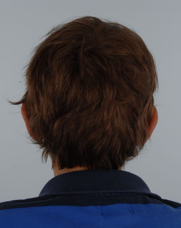 Otoplasty Case 2883 After Photo Otoplasty