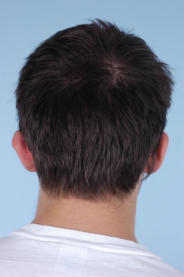 Otoplasty Case 2899 After Photo Otoplasty