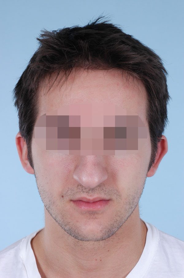 Otoplasty Case 2899 After Photo Otoplasty