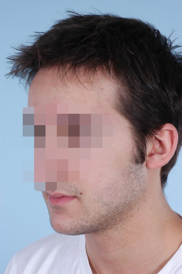 Otoplasty Case 2899 After Photo Otoplasty