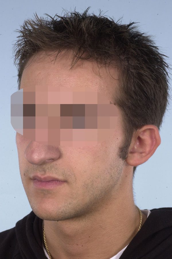 Otoplasty Case 2899 Before Photo Otoplasty