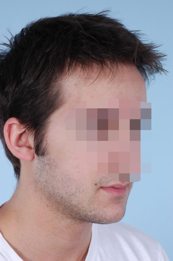 Otoplasty Case 2899 After Photo Otoplasty