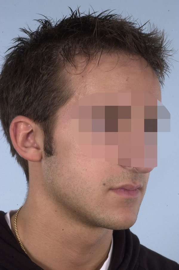 Otoplasty Case 2899 Before Photo Otoplasty