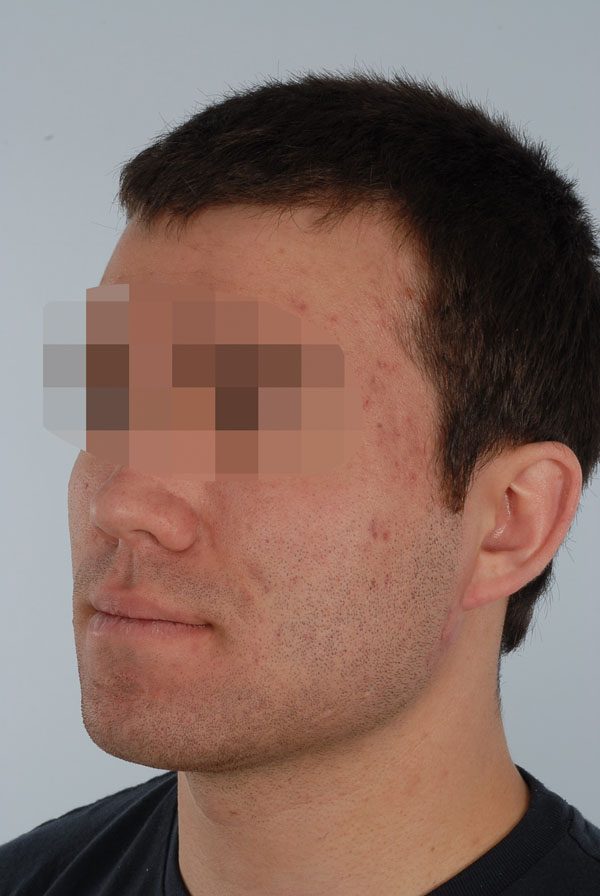 Otoplasty Case 2909 Before Photo Otoplasty