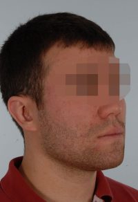 Otoplasty