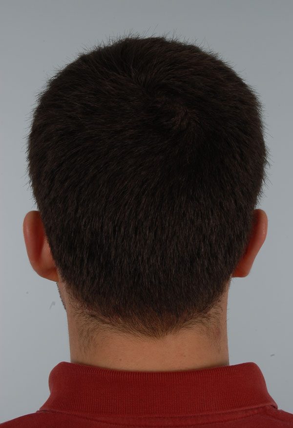Otoplasty Case 2909 After Photo Otoplasty