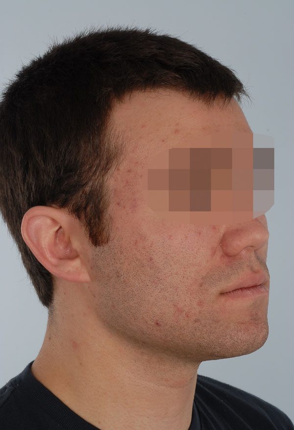 Otoplasty Case 2909 Before Photo Otoplasty