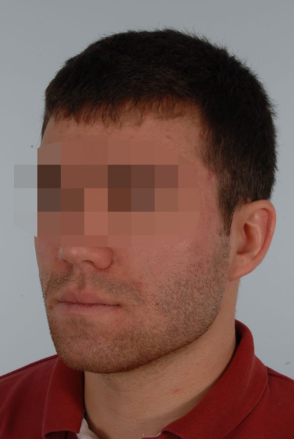 Otoplasty Case 2909 After Photo Otoplasty