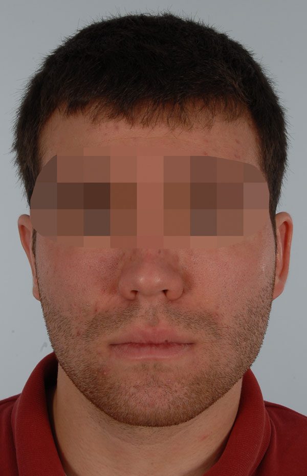 Otoplasty Case 2909 After Photo Otoplasty