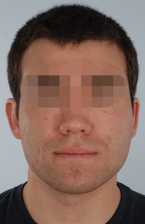 Otoplasty Case 2909 Before Photo Otoplasty