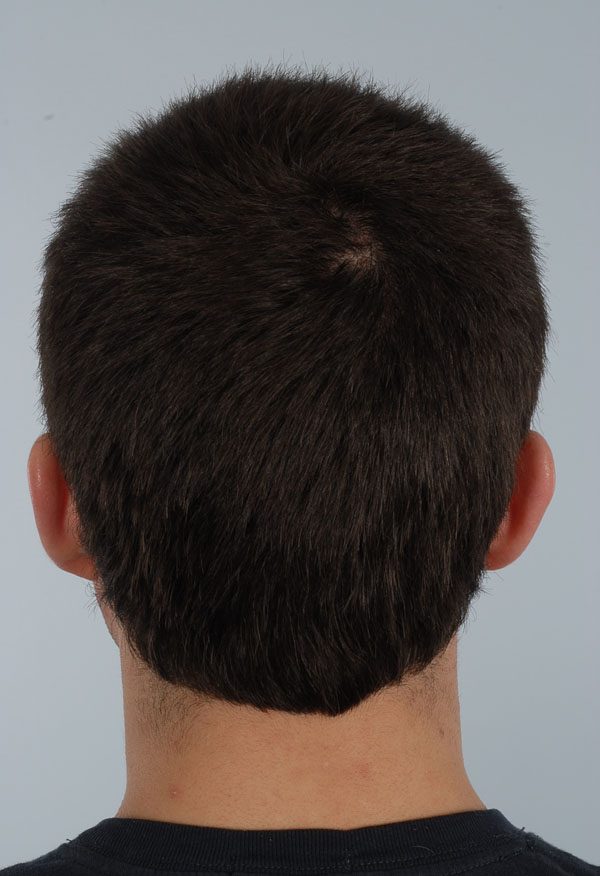 Otoplasty Case 2909 Before Photo Otoplasty