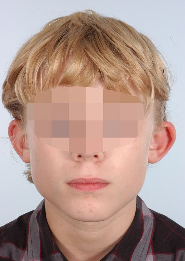 Otoplasty Case 2919 Before Photo Otoplasty