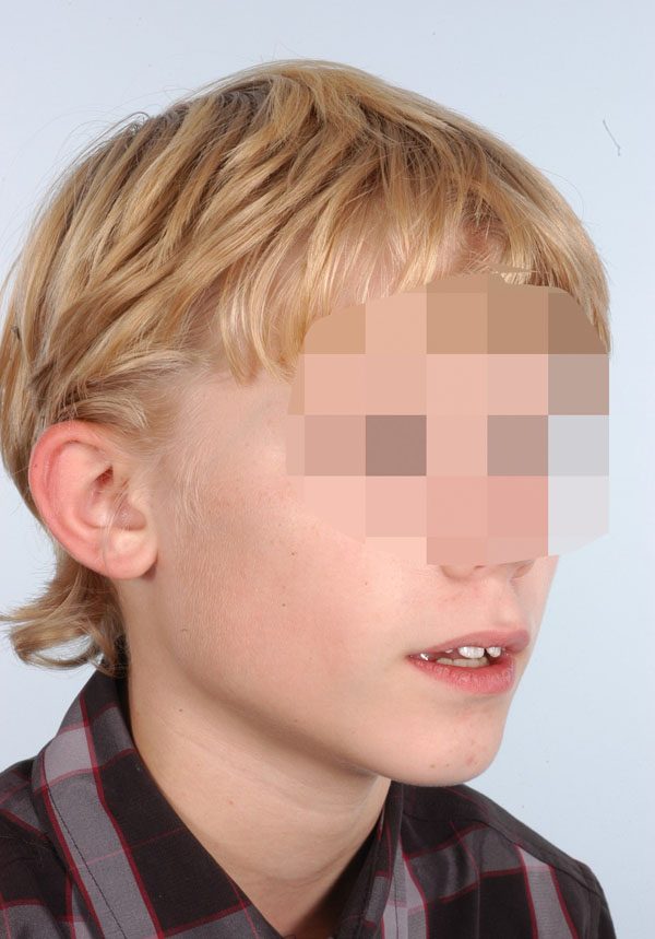 Otoplasty Case 2919 Before Photo Otoplasty