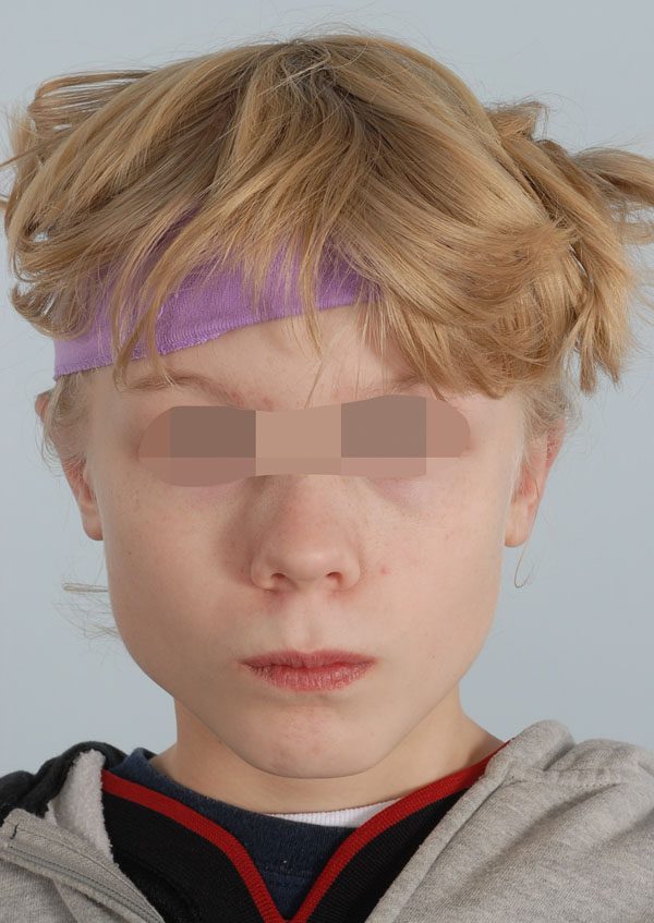 Otoplasty Case 2919 After Photo Otoplasty