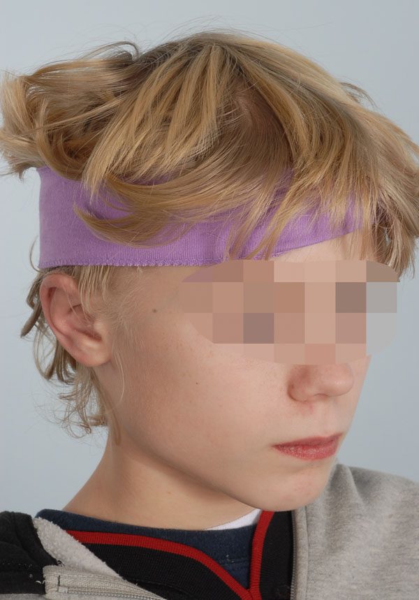 Otoplasty Case 2919 After Photo Otoplasty