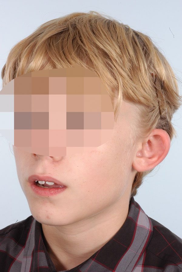 Otoplasty Case 2919 Before Photo Otoplasty