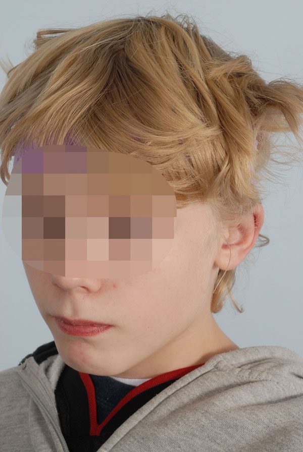 Otoplasty Case 2919 After Photo Otoplasty