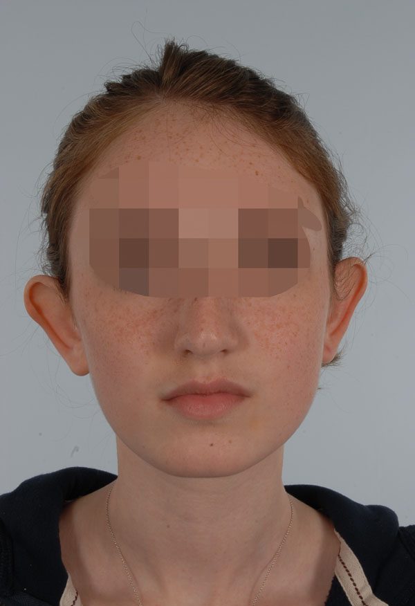 Otoplasty Case 2929 Before Photo Otoplasty