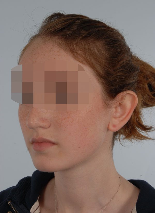 Otoplasty Case 2929 Before Photo Otoplasty